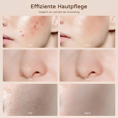 Before and after close-up of nose pores after using COOL-i LED light therapy mask

